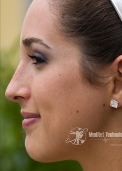 After Image: Rhinoplasty Case 1 - left-side