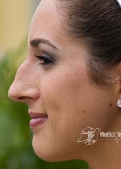 Before Image: Rhinoplasty Case 1 - left-side