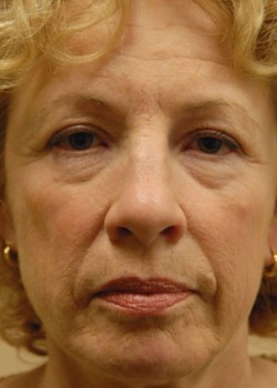 Before Image: Face Lift, Upper & Lower Eyelid - front