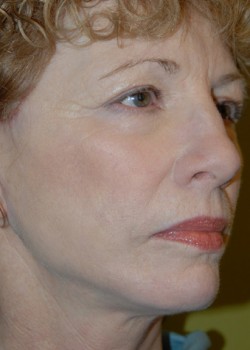 After Image: Face Lift, Upper & Lower Eyelid - right-front-oblique