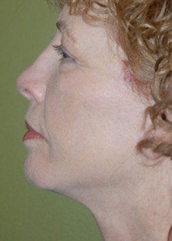 After Image: Face Lift, Upper & Lower Eyelid - other