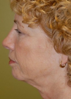 Before Image: Face Lift, Upper & Lower Eyelid - other