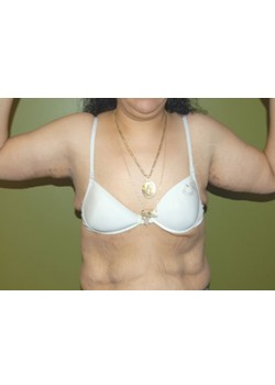 After Image: Arm Lift - front