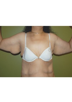 Before Image: Arm Lift - front
