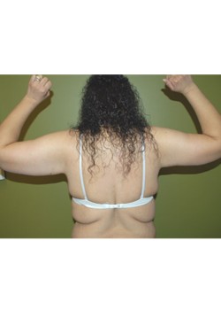 After Image: Arm Lift - back