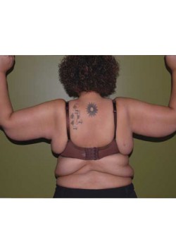 After Image: Arm Lift - back