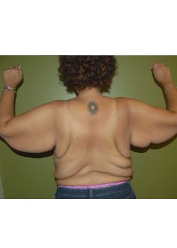 Before Image: Arm Lift - back
