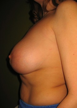 After Image: Breast Lift with Implants - other