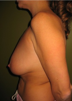 Before Image: Breast Lift with Implants - other