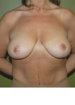 After Image: Breast Lift - front