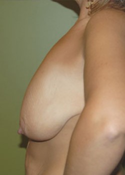 Before Image: Breast Lift - other