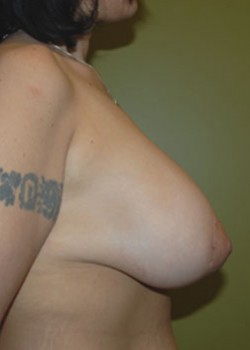 After Image: Breast Lift with Implants - other