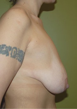 Before Image: Breast Lift with Implants - other