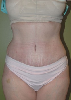 After Image: Tummy Tuck with Liposuction - front