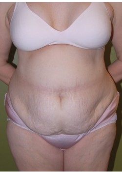 Before Image: Tummy Tuck with Liposuction - front