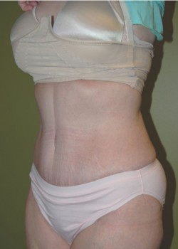 After Image: Tummy Tuck with Liposuction - left-front-oblique