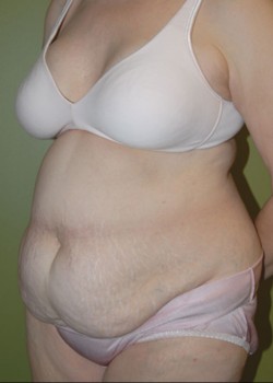 Before Image: Tummy Tuck with Liposuction - left-front-oblique