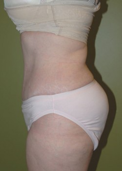 After Image: Tummy Tuck with Liposuction - front