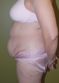 Before Image: Tummy Tuck with Liposuction - front