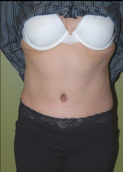 After Image: Tummy Tuck with Liposuction - front