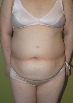 Before Image: Tummy Tuck with Liposuction - front