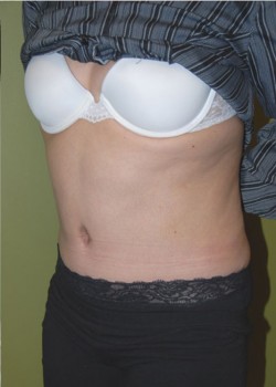 After Image: Tummy Tuck with Liposuction - left-front-oblique