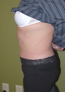 After Image: Tummy Tuck with Liposuction - other