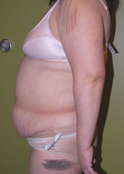 Before Image: Tummy Tuck with Liposuction - other