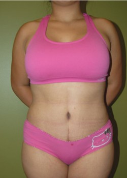 After Image: Tummy Tuck with Liposuction - front