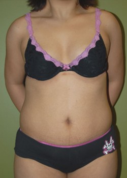 Before Image: Tummy Tuck with Liposuction - front