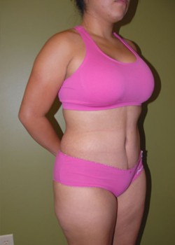 After Image: Tummy Tuck with Liposuction - right-front-oblique