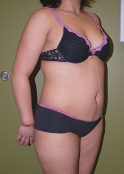 Before Image: Tummy Tuck with Liposuction - right-front-oblique