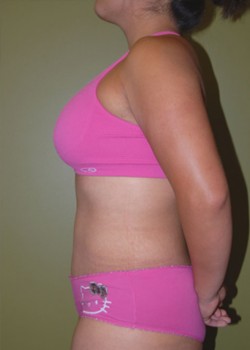 After Image: Tummy Tuck with Liposuction - other