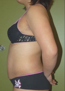 Before Image: Tummy Tuck with Liposuction - other