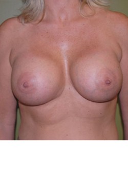 After Image: Breast Augmentation - front