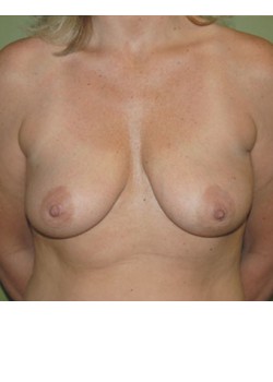 Before Image: Breast Augmentation - front