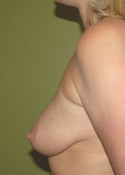 Before Image: Breast Augmentation - other