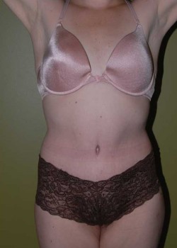 After Image: Tummy Tuck with Liposuction - front