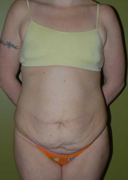 Before Image: Tummy Tuck with Liposuction - front