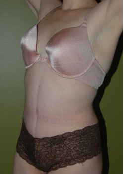 After Image: Tummy Tuck with Liposuction - left-front-oblique