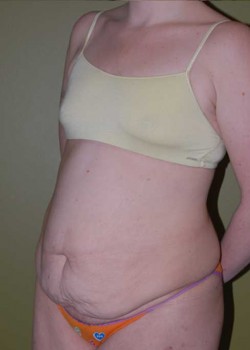 Before Image: Tummy Tuck with Liposuction - left-front-oblique