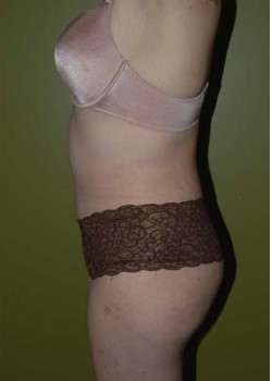 After Image: Tummy Tuck with Liposuction - other