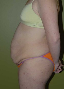Before Image: Tummy Tuck with Liposuction - other