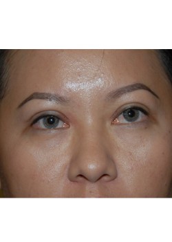 After Image: Asian Double Eyelid - front