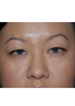 Before Image: Asian Double Eyelid - front