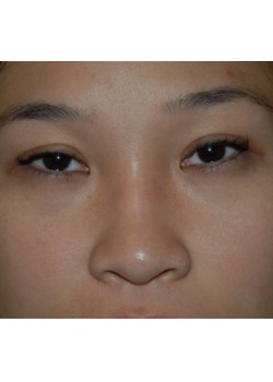 After Image: Asian Double Eyelid - front