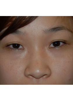 Before Image: Asian Double Eyelid - front