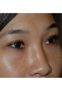 After Image: Asian Double Eyelid - right-front-oblique