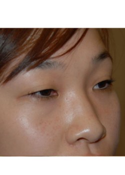 Before Image: Asian Double Eyelid - right-front-oblique