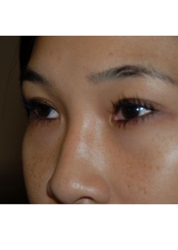 After Image: Asian Double Eyelid - left-front-oblique